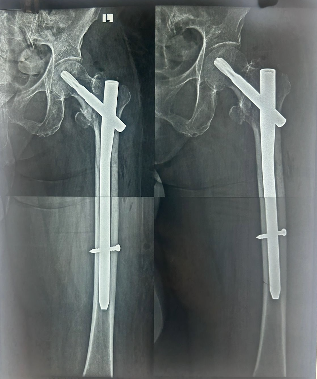 Fracture Care