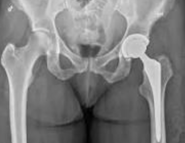 Hip Replacement