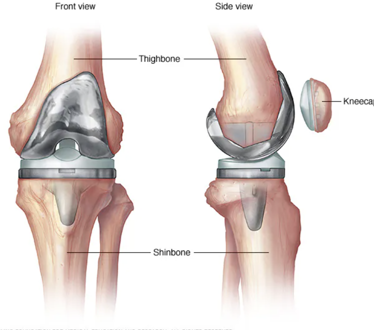 Knee Replacement